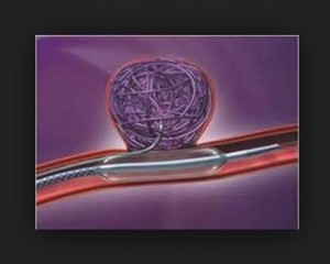 Balloon assisted coil