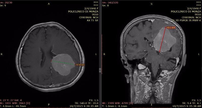 RMN preop